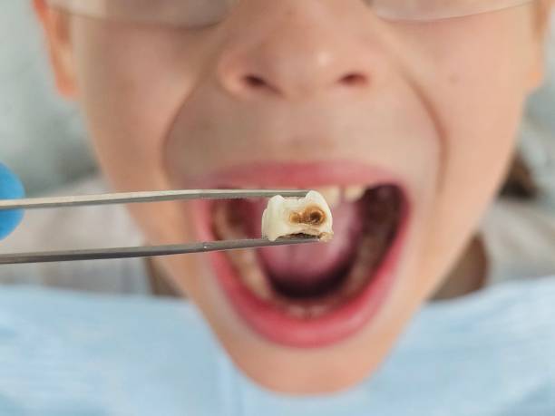Best Tooth Infection Emergency Dentist  in Lannon, WI